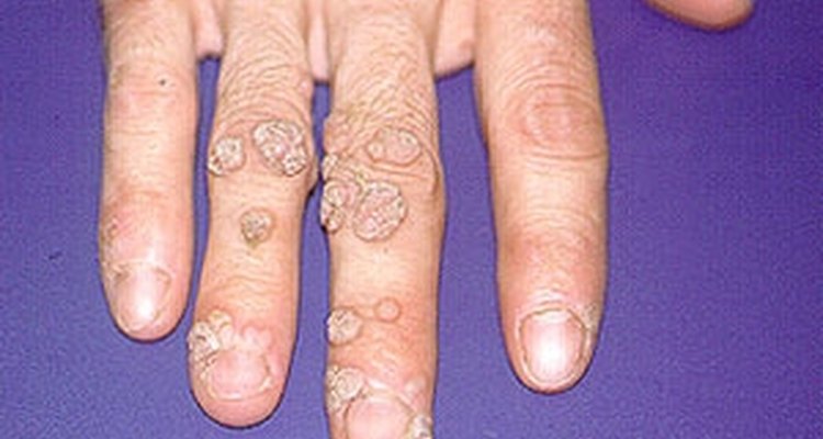 Hands are common places for warts.