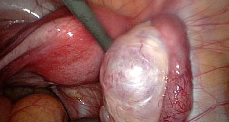 Existem diversos tipos de cistos no ovário