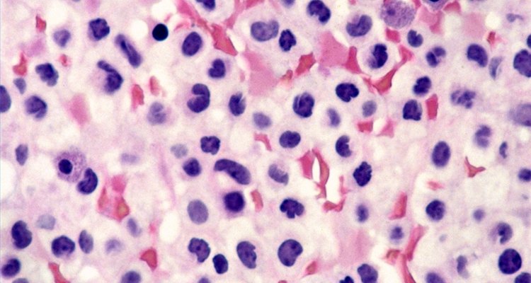 As leucemias podem ser diagnosticadas microscopicamente