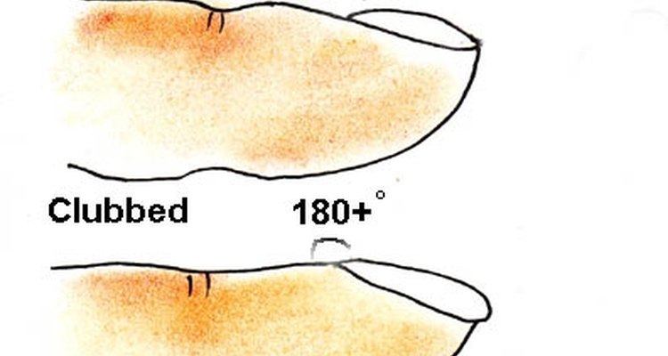O ângulo na base ungueal, que deve ser ligeiramente côncavo em cerca de 165 graus, começa a se achatar em 180 graus ou mais