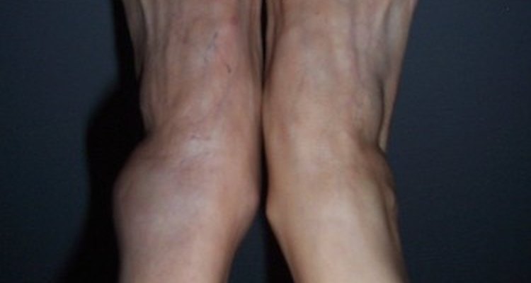 deep vein thrombosis bruise