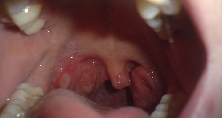 A cirurgia para remover as tonsilas pode ser necessária