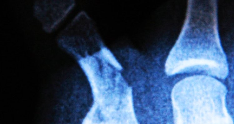 Lesões devido a osteoartrite podem causar esclerose óssea