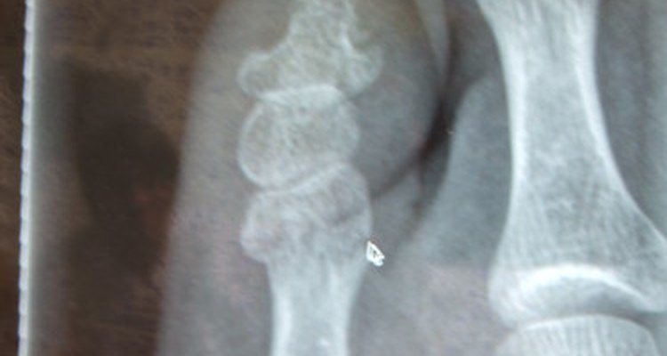 Gout