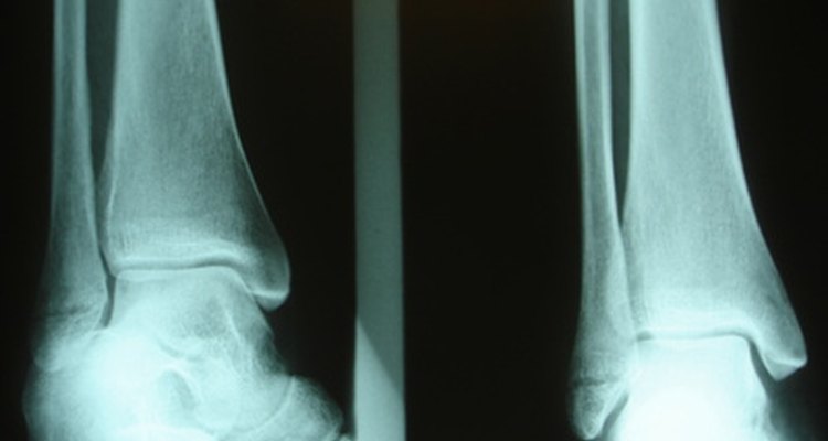 Aircasts are used to treat injuries ranging from minor sprains to major fractures.