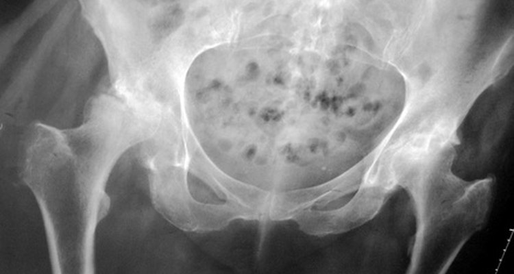 Um hemangioma lombar é um tipo de tumor que cresce na sua coluna