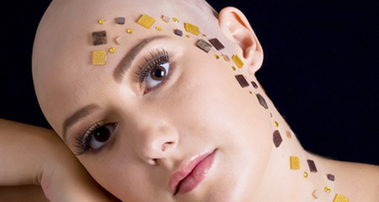 La alopecia areata es una enfermedad autoinmune que causa la pérdida de cabello.