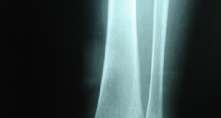 Una fractura de tobillo puede necesitar de tornillos y placas para reparar.