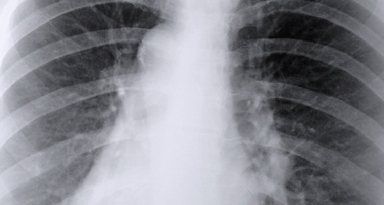Una radiografía del tórax puede ayudar a determinar si tienes una infección por ingestión de alimentos.
