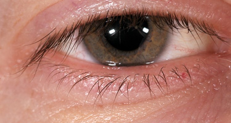 cataract surgery detached retina symptoms