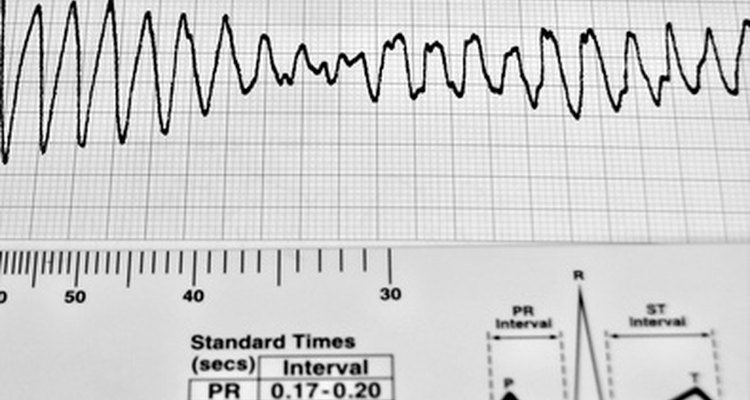 Un marcapasos mide la velocidad a la cual el corazón late.
