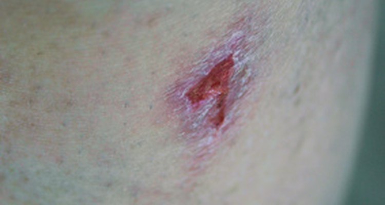 Es común que el área de la herida se hinche.