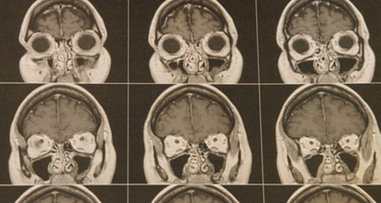 Acoustic neuromas and meningiomas are most commonly diagnosed on MRI scans.