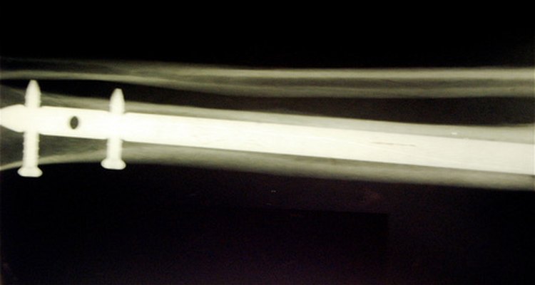 Surgical screws and plates have been in use since the 1930s.