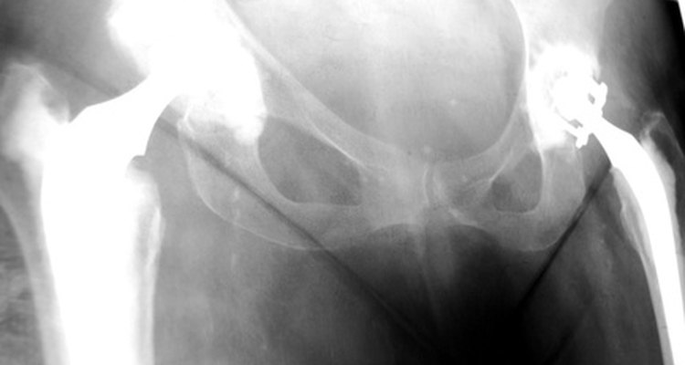Implantes de titânio no quadil são compatíveis com ressonância magnética