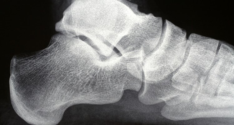 Los desgarros de ligamentos son más comunes en los tobillos, las rodillas y los dedos.