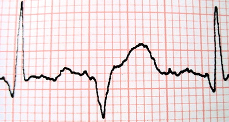 El ritmo cardíaco puede acelerarse en algunos casos.