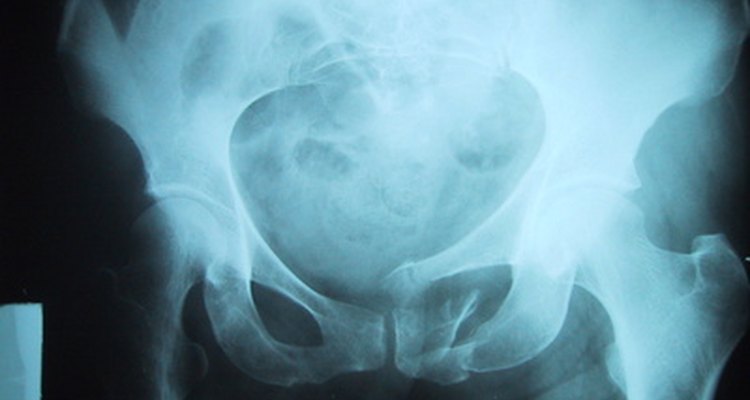 A presença de flebólitos em geral só é conhecida depois que o indivíduo se submete a raios X por outros problemas de saúde