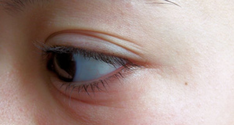 An insect bite in the eye area is especially bothersome.