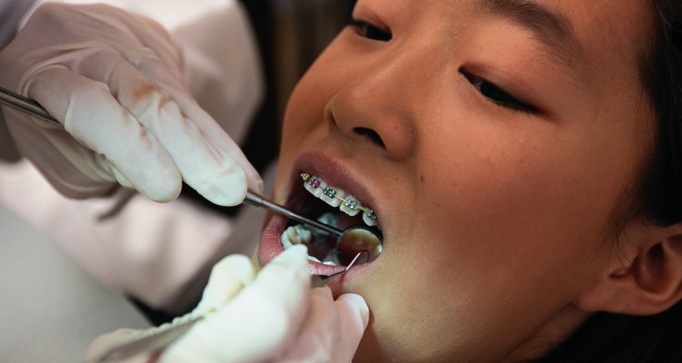 Los frenos de ortodoncia mejoran el aspecto de los dientes y la mordida.
