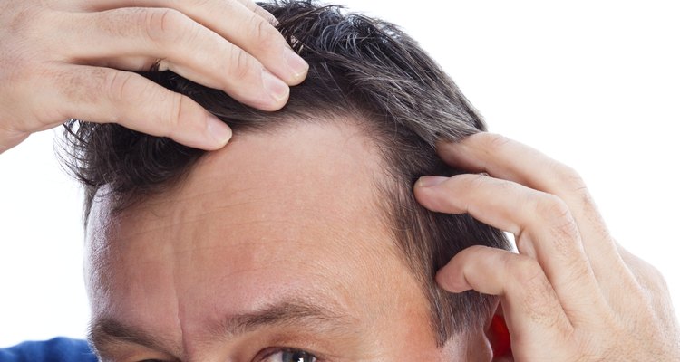 Androgenic Alopecia