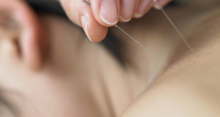 A acupuntura ajuda a combater a ansiedade, proporcionando uma boa noite de sono