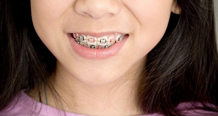 Un ortodoncista puede utilizar los frenos para ayudar a ubicar los dientes más juntos.
