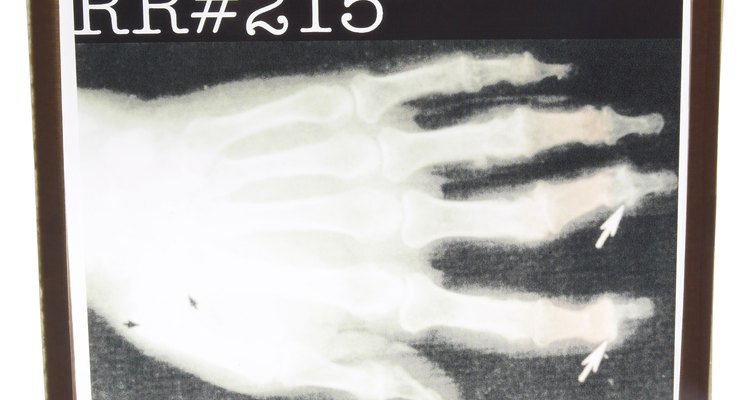 X-ray of an arthritic hand