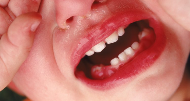 Un trapo frío puede ayudar a tratar el dolor por dentición de un bebé.