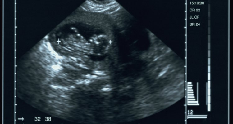 Meça o diâmetro biparietal e fronto-occipital da cabeça do feto através de ultrassom