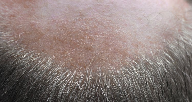 Balding senior man, rear view, close-up of top of head