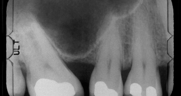 X-ray of three teeth with fillings