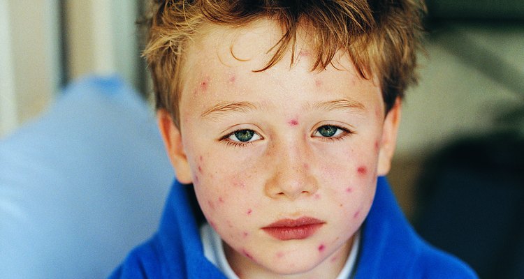 Calamine lotion will dry and stick around scabs from chickenpox.