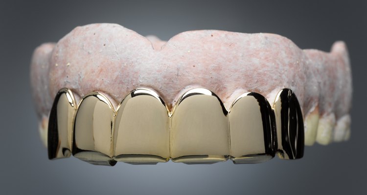 Aquí encontrarás cómo colocar una corona dental cuando no tienes acceso a un dentista.