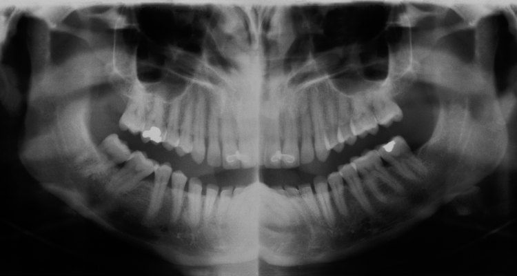 Preencha os orifícios dos seus dentes com cimento obturador provisório de venda livre até ir ao dentista