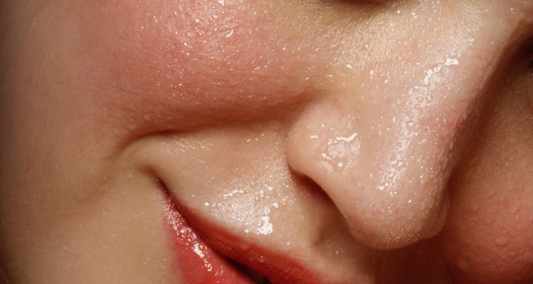A acne não pode ser tratada com cloridrato de terbinafina