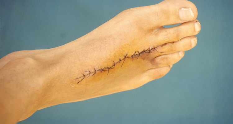 Tu médico puede aconsejarte que pruebes la cinta micropore en una cicatriz.