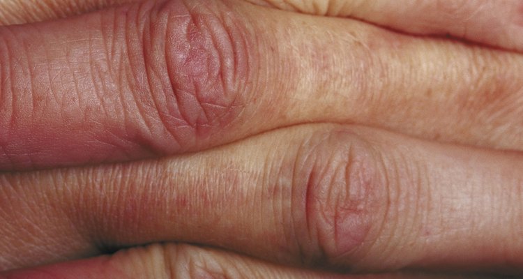 Knuckle pads usually develop in the middle joint of the finger.