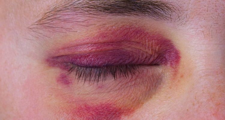 Human eye with a purple bruise