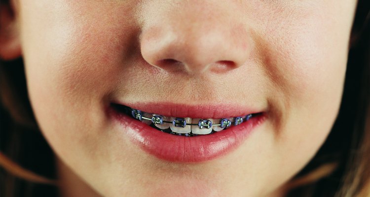 Si el espacio se mantiene después de que los dientes permanentes de tu hijo salen, probablemente no va a desaparecer sin un tratamiento ortodóncico.