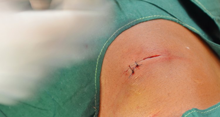 Incision wound suture.