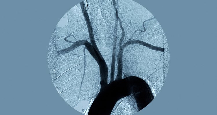 A arteriosclerose, também conhecida como o enrijecimento das artérias, é o estreitamento gradual e enrijecimento das artérias devido à calcificação