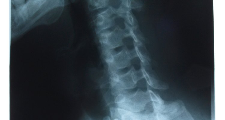 Um nervo cervical inflamado que causa dor na região do pescoço e dos ombros normalmente ocorre na raiz nervosa C5