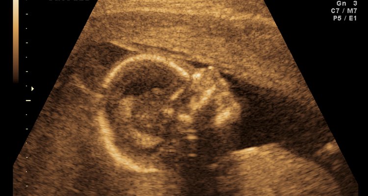 Imagem de ultrassom do bebê