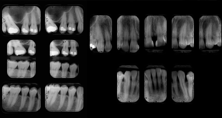 X-rays help illustrate the number of decayed, missing and filled teeth.