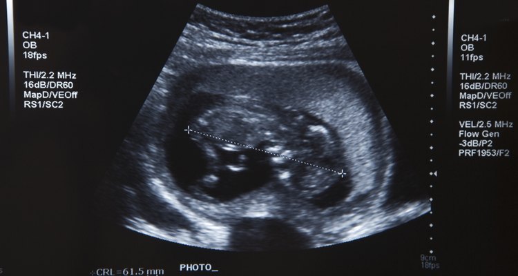 O ultrassom é a primeira imagem de seu novo bebê
