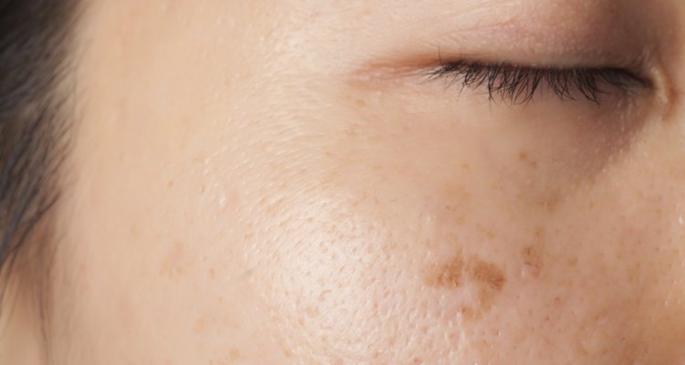 Blemish and spots