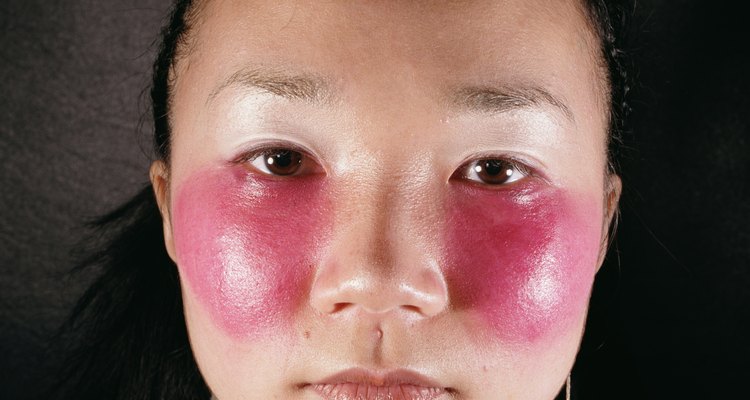 Bochechas avermelhadas podem ser o resultado de pele seca ou doenças de pele