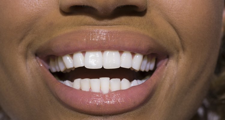 O esmalte de dentes não adere a dentes molhados