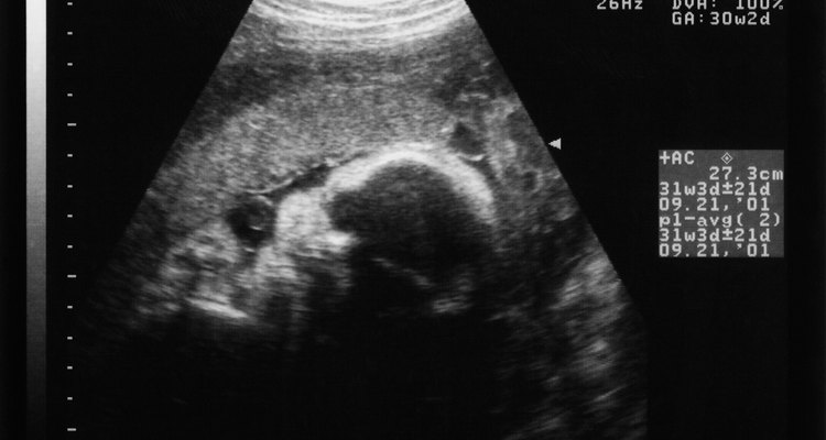 Ultrassonografia do bebê